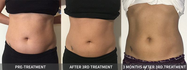 truSculpt id Transformation