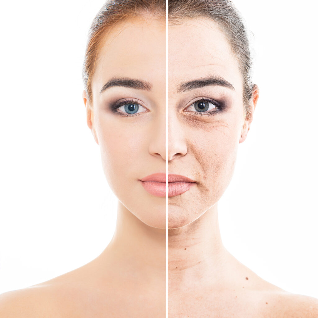 age spots
