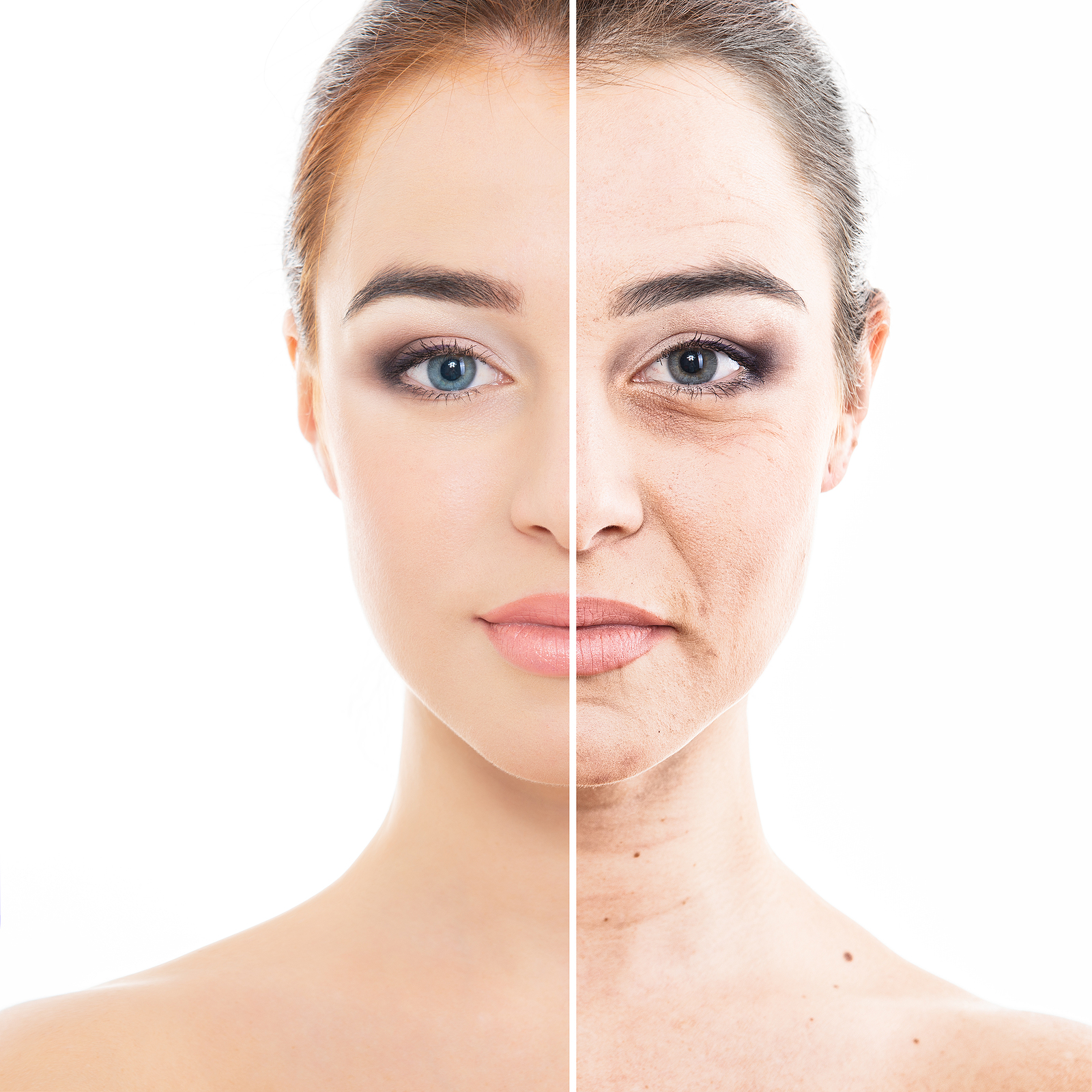age spots